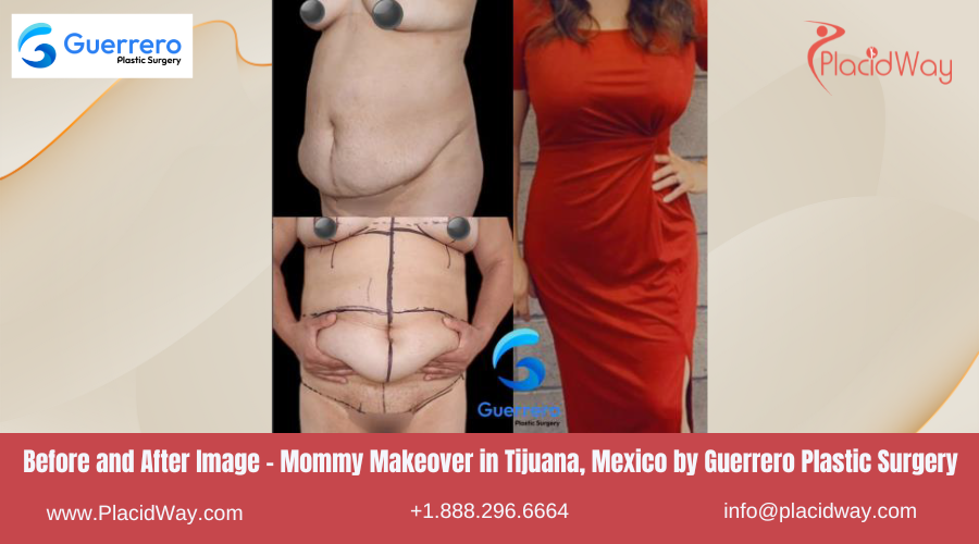 MMO in Tijuana Mexico by Guerrero Plastic Surgery