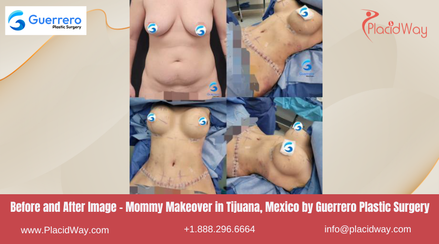 Mommy Makeover in Tijuana Mexico by Guerrero Center