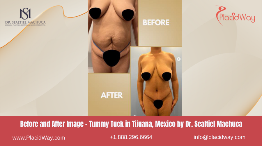 Tummy Tuck in Tijuana Mexico - Dr Sealtiel