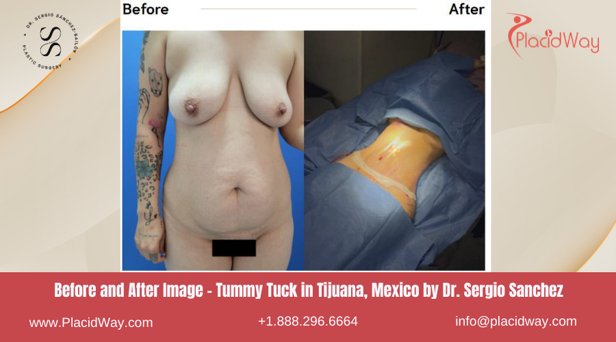 Tummy Tuck in Tijuana Mexico - Dr Sergio Sanchez
