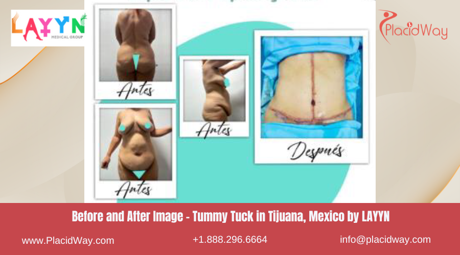 Tummy Tuck in Tijuana Mexico by LAYYN Medical Group