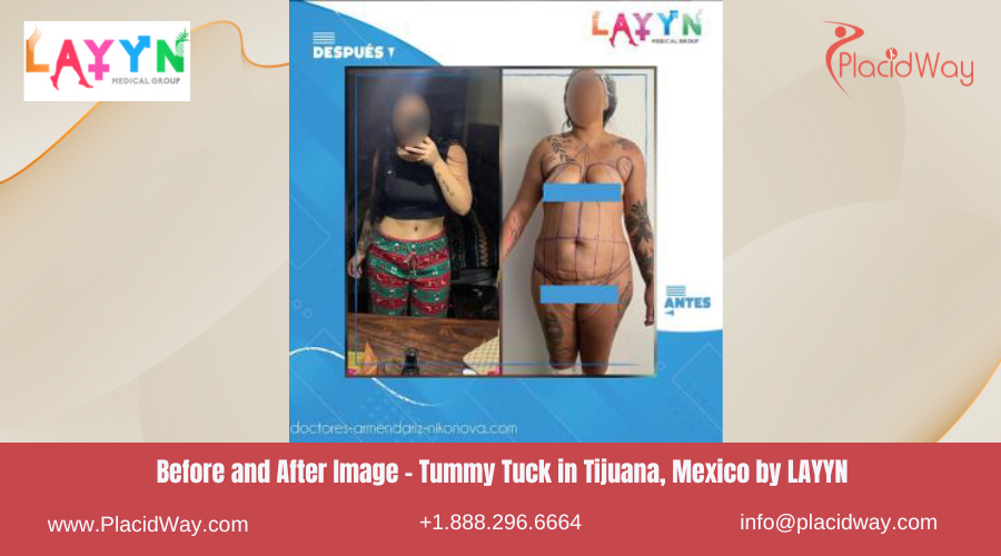 Tummy Tuck in Tijuana Mexico - LAYYN Center