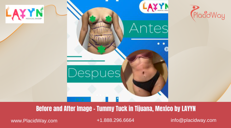 Tummy Tuck in Tijuana Mexico - LAYYN Clinic