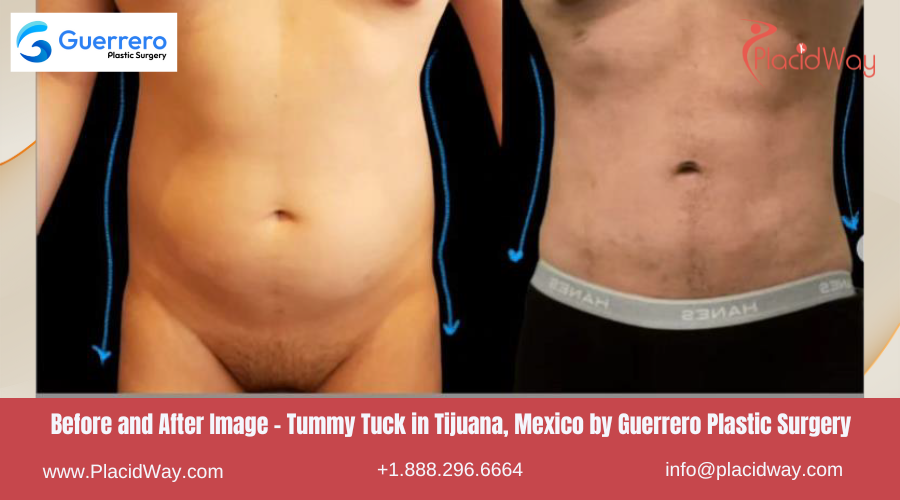 Tummy Tuck in Tijuana Mexico by Guerrero Plastic Surgery