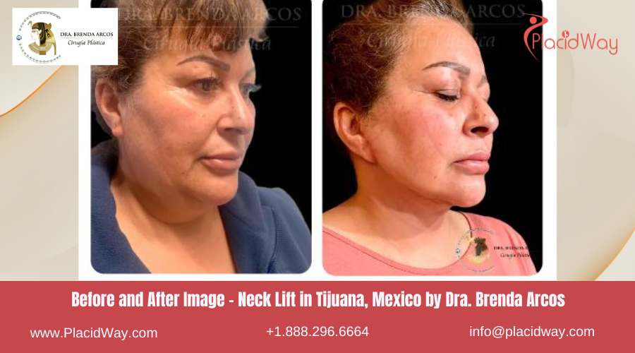 Neck Lift in Tijuana Mexico - Dra Brenda Arcos