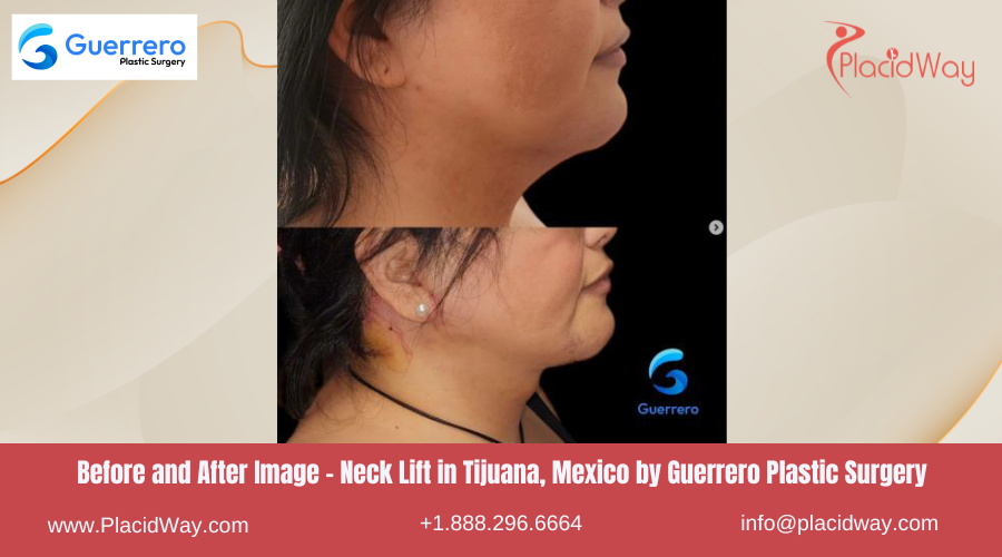 Neck Lift in Tijuana Mexico - Guerrero Plastic Surgery Center