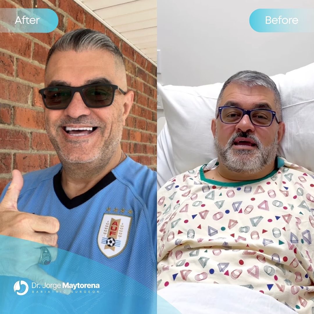 Gastric Bypass in Tijuana, Mexico at Dr. Maytorena