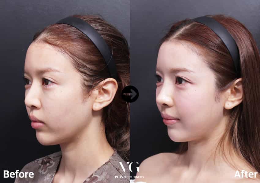 Korean Nose Jobs Before And After