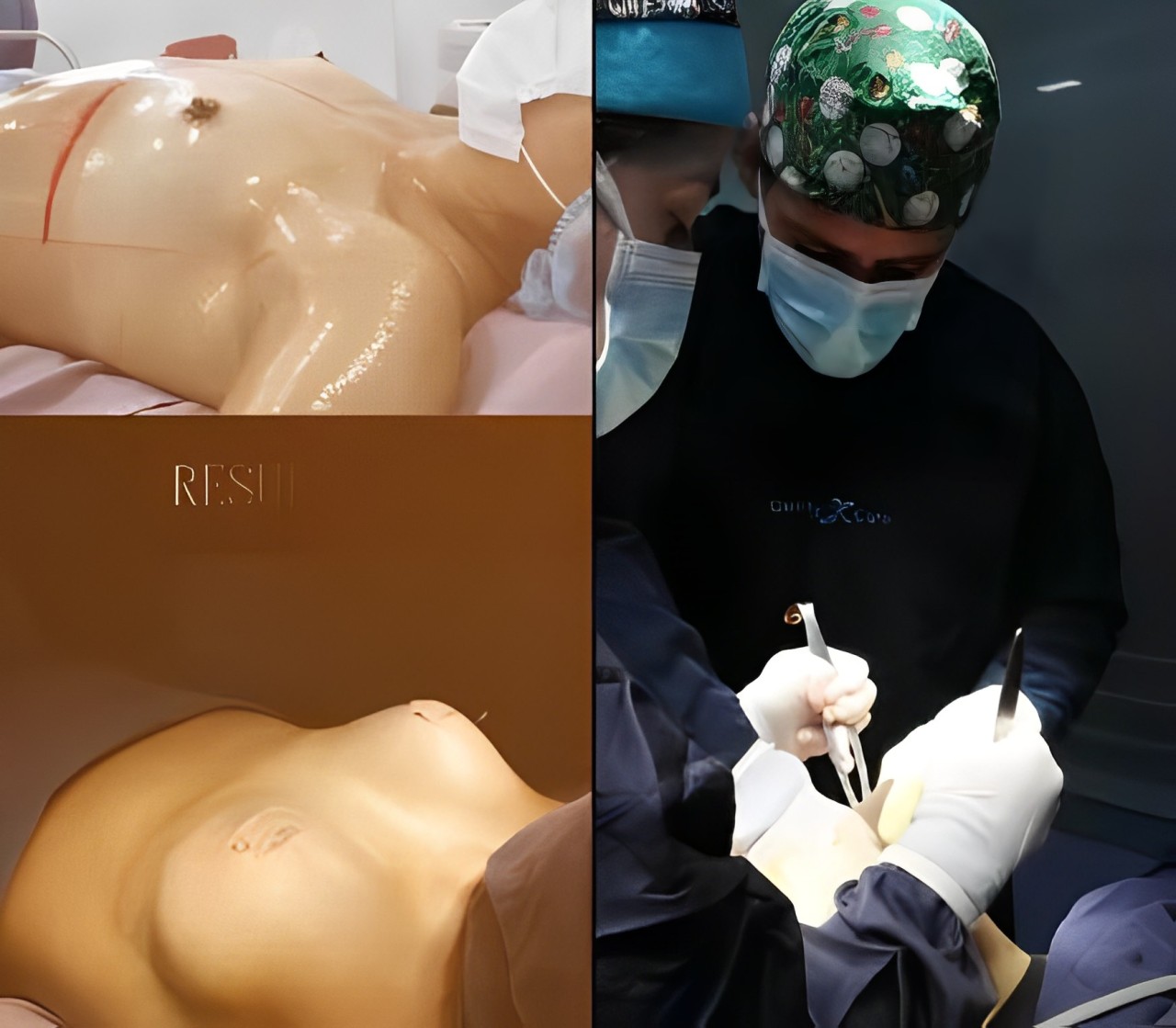 Breast Augmentation in Bogota, Colombia