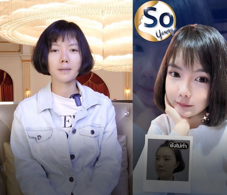Cheekbone Surgery in Bangkok, Thailand - Wawa Story