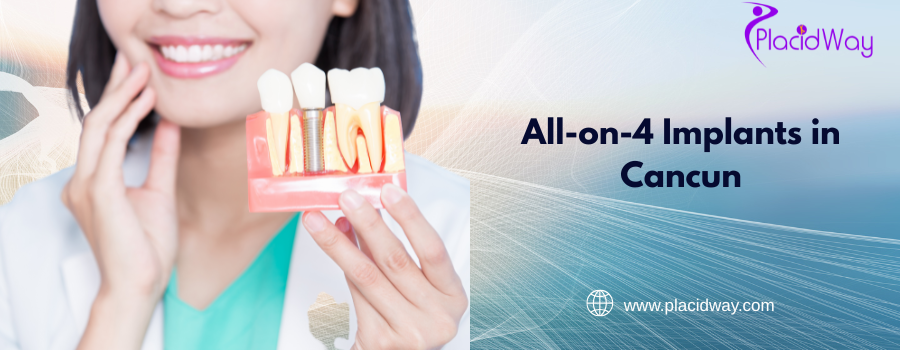 All on 4 Dental Implants