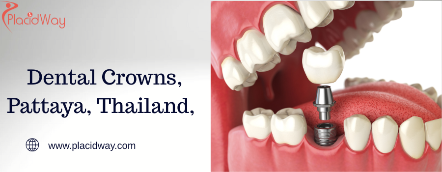 Dental Crowns, Pattaya, Thailand,