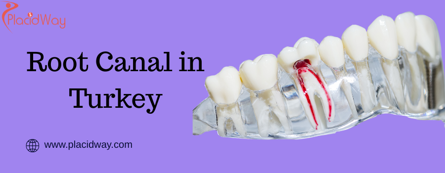 Root Canal in Turkey