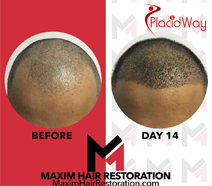 Maxim Hair Restoration - Hair Transplantation in Makati, Philippines Maxim Hair Restoration - Hair Transplantation in Makati, Philippines