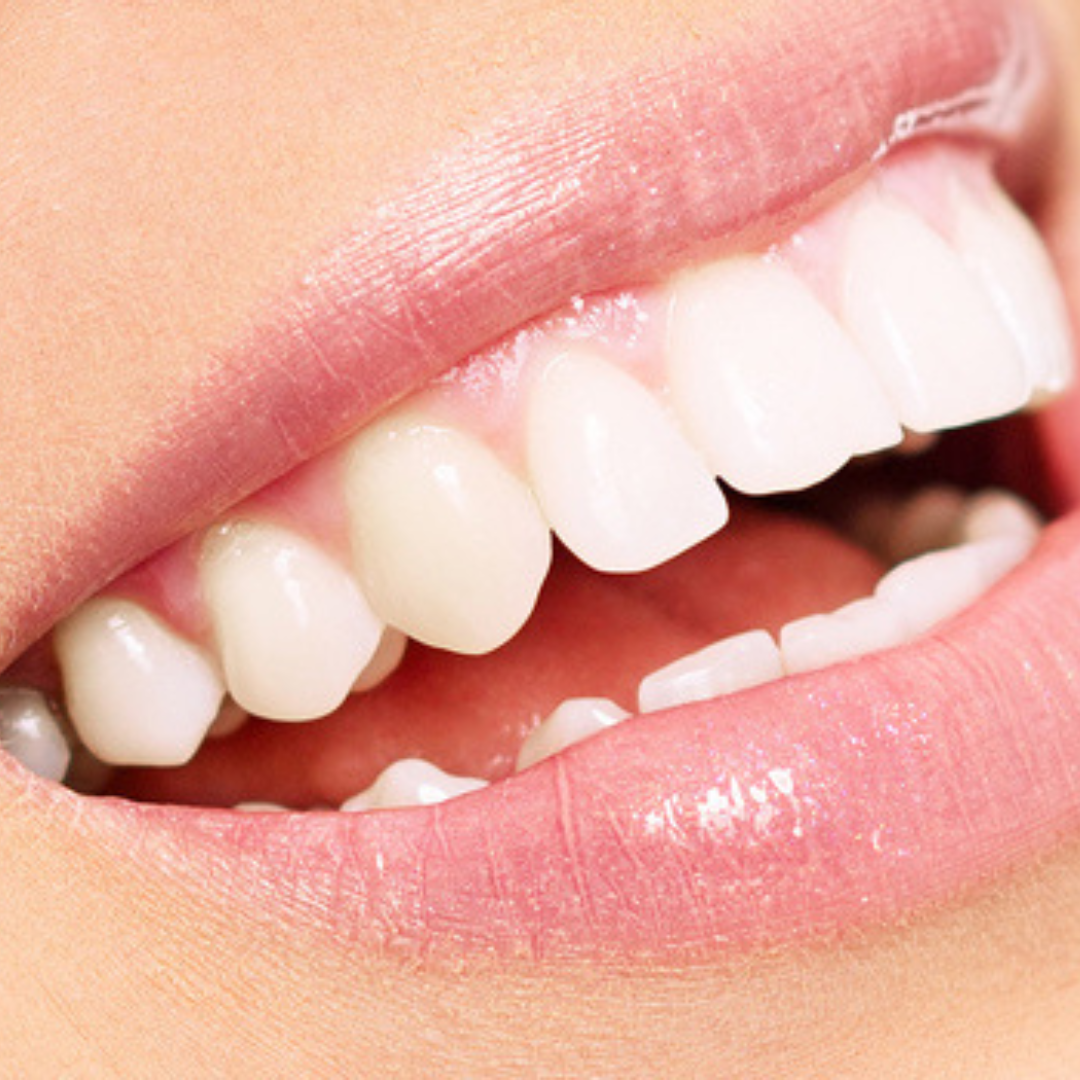 Best Dentists for Veneers in Tijuana Mexico