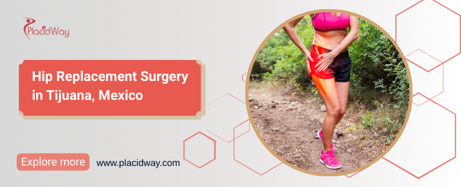 Hip Replacement Surgery in Tijuana, Mexico