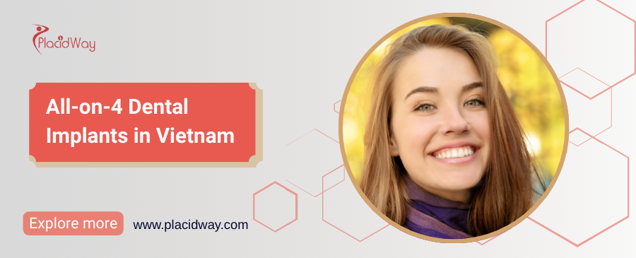 All-on-4 Dental Implants in Vietnam