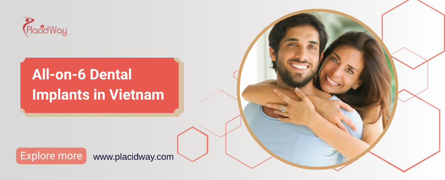 All-on-6 Dental Implants in Vietnam