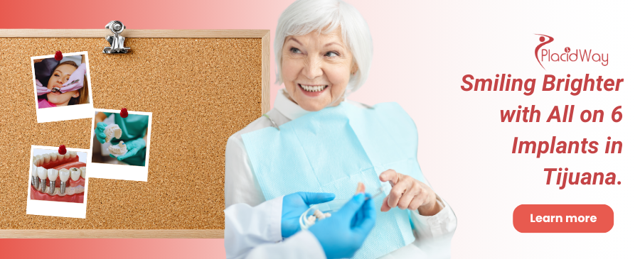 All on 6 Dental Implants in Tijuana, Mexico