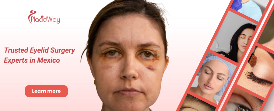 Eyelid Surgery in Tijuana, Mexico