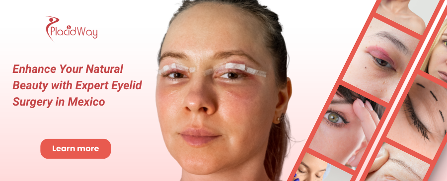 Eyelid Surgery in Mexico City, Mexico