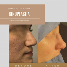 Rhinoplasty Package in Reynosa, Mexico by Hospital Los Lagos 