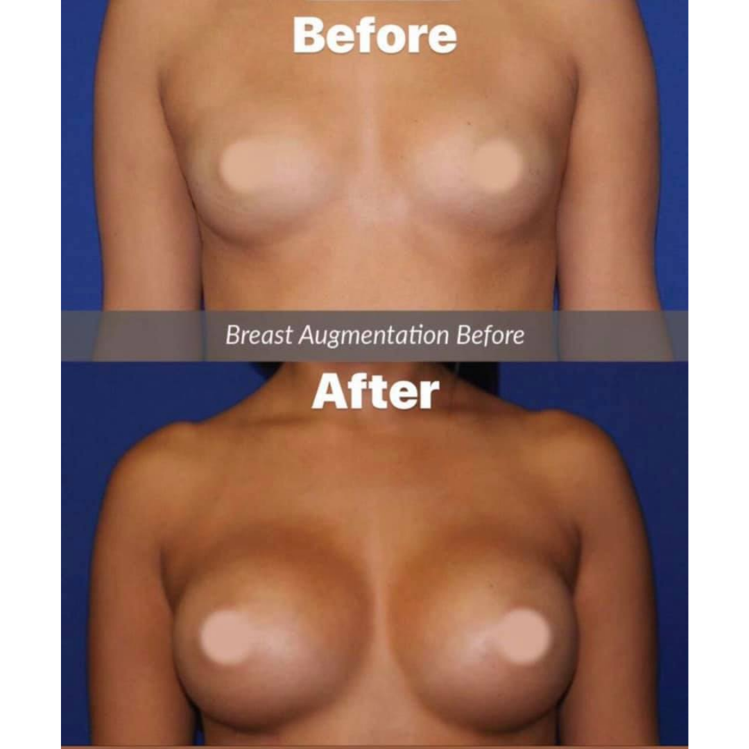 Low Cost Breast Augmentation in Reynosa, Mexico - $3,500