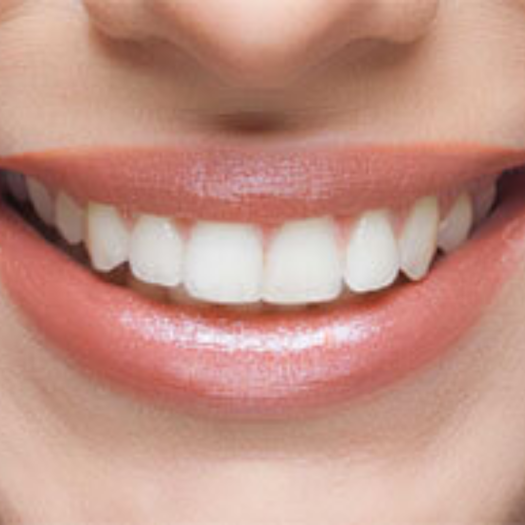 Bergedent Clinic Full Mouth All in 4 - All in 6 Package in Istanbul, Turkey