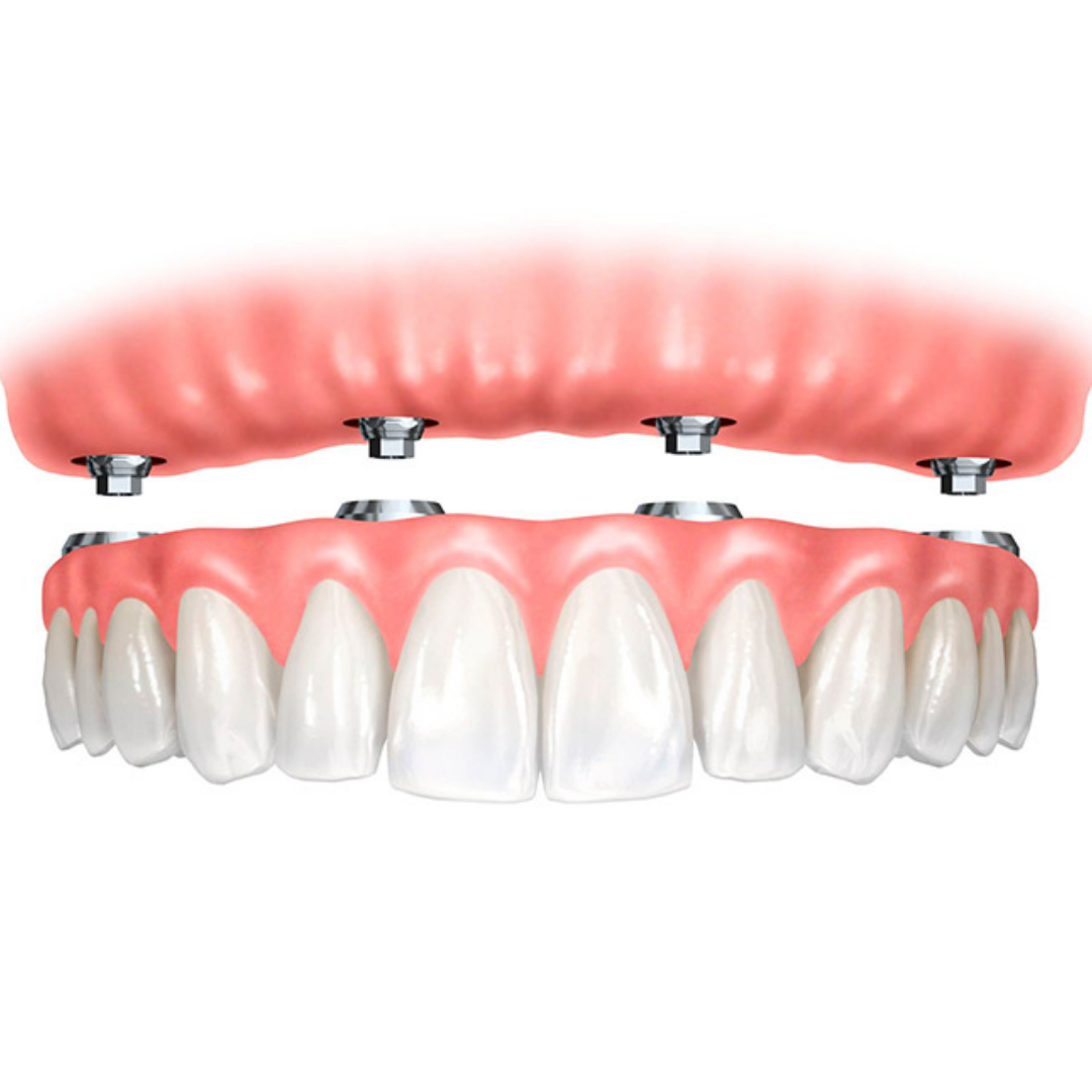 Full Dentures at Americas Dental Care Costa Rica