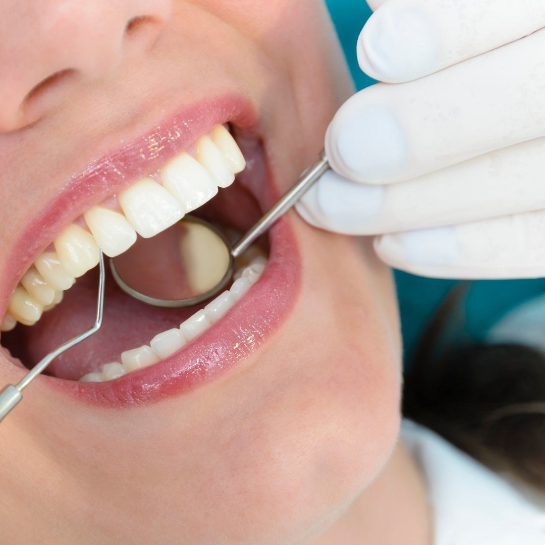 High Quality Dental Fillings Package in Los Algodones Mexico