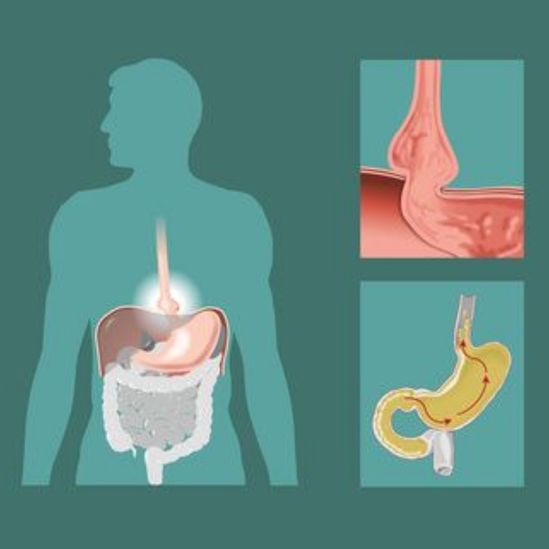 Low Cost Package for Hiatal Hernia Repair in Merida, Mexico