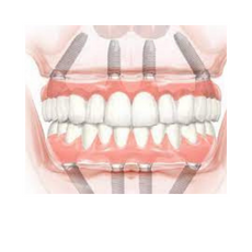 Best Package for All on 4 Dental Implants in Cancun, Mexico