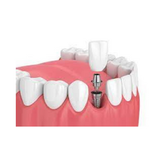 Affordable Packages for Dental Implants in Cancun, Mexico