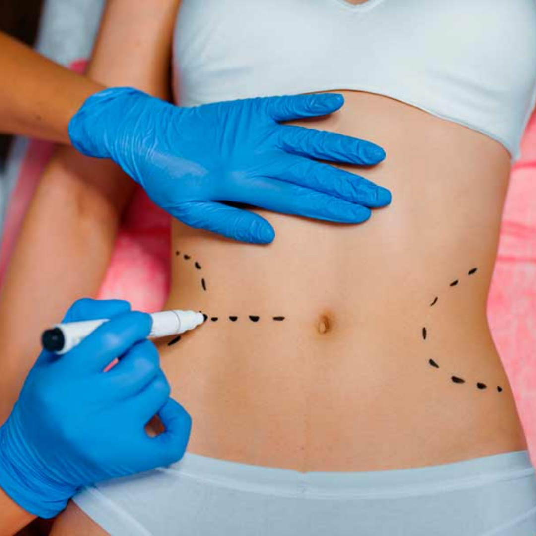 Cheap Package for Liposuction in Cancun - $1,500