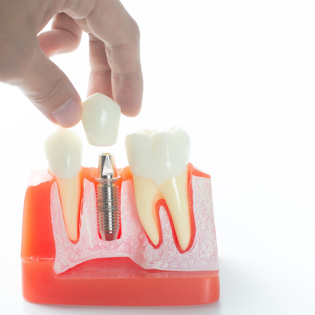 Dental Implants in Bogota Colombia - Starting Cost $800