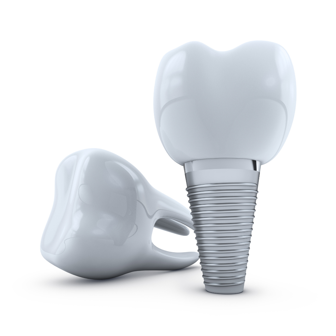 Dental Implants in Puerto Vallarta, Mexico - Cost $1250