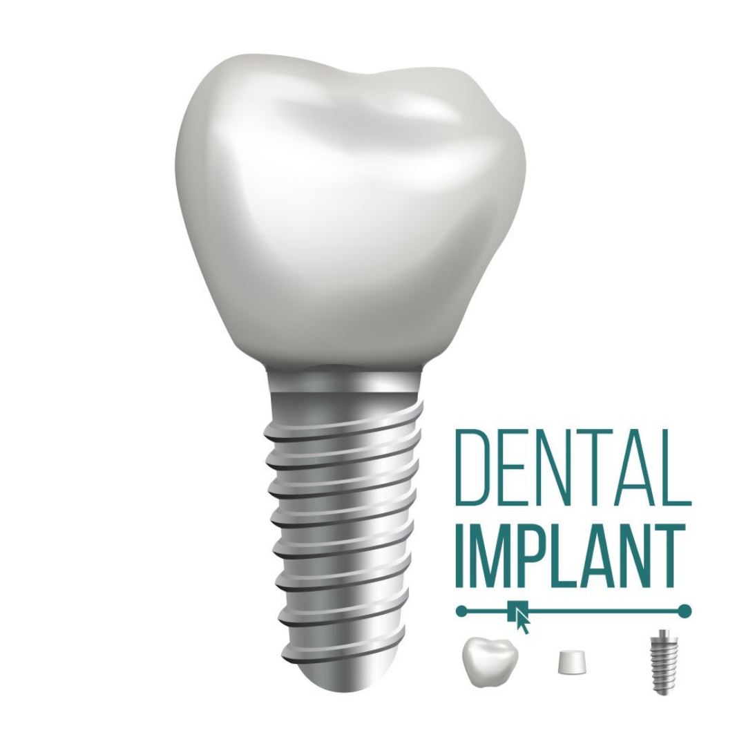 Dental Implants Package in Bangalore India