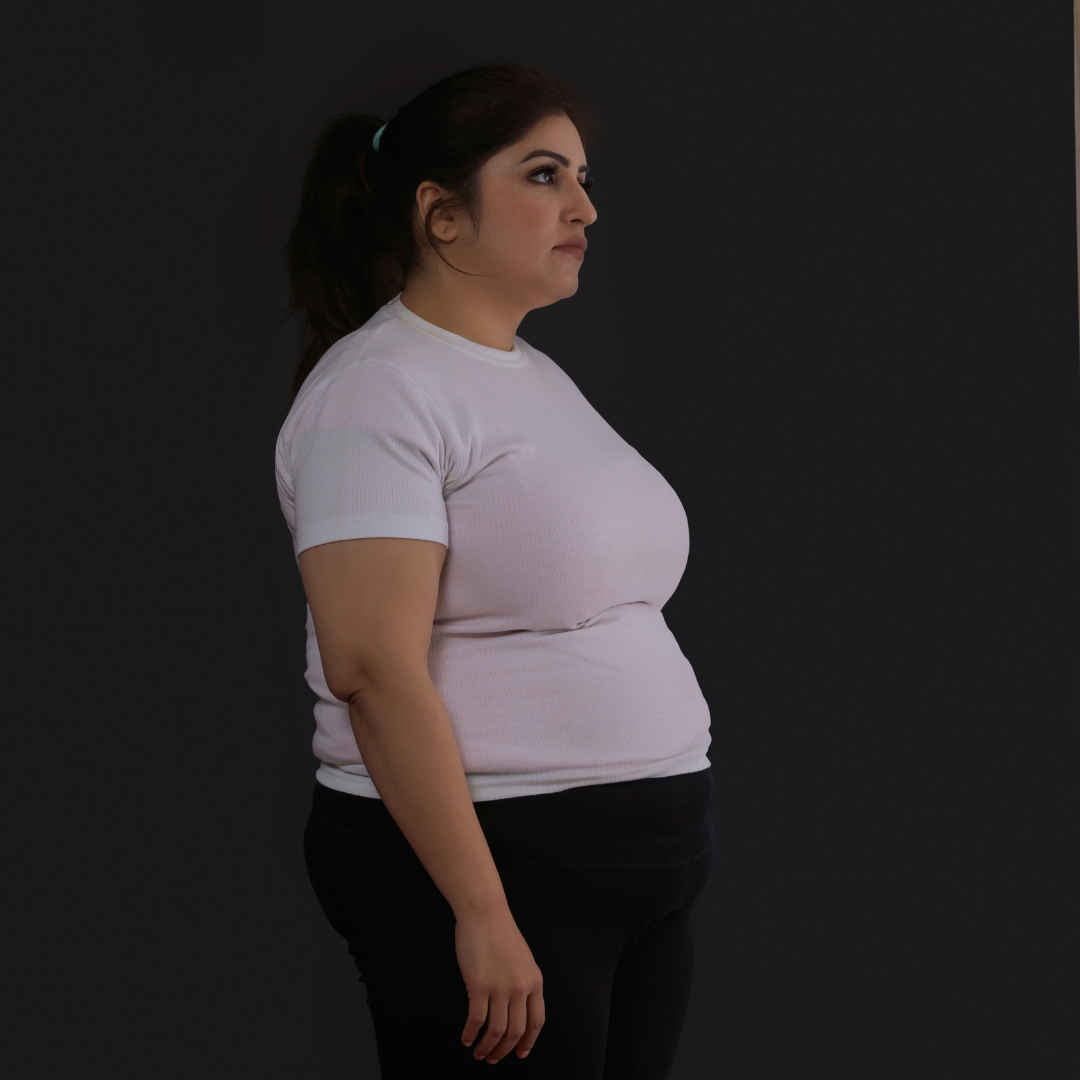 Best Roux-en-Y Gastric Bypass Revision Surgery in Tijuana, Mexico