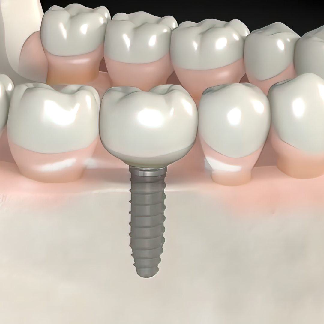 High-Quality Dental Implants in Los Algodones, Mexico