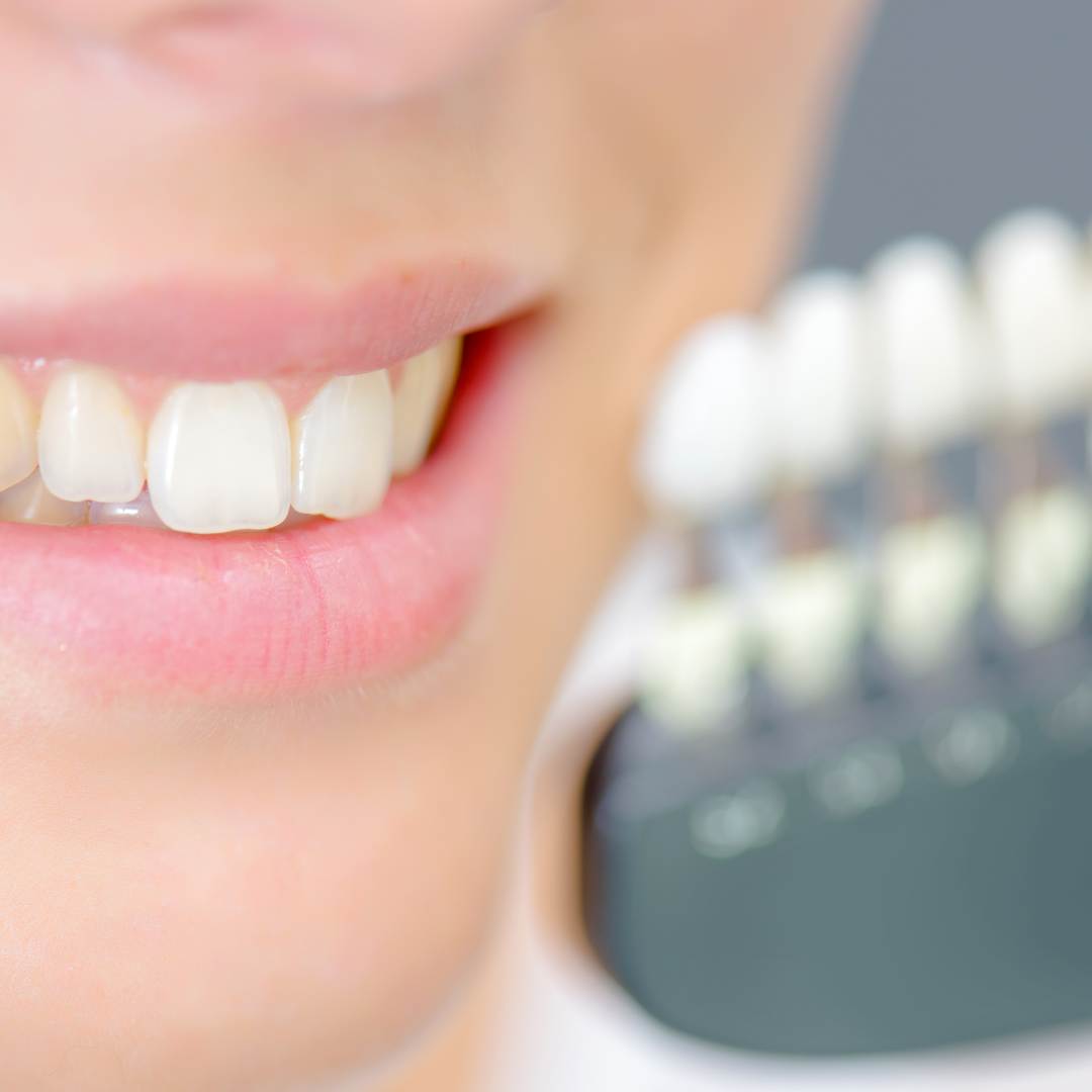 Affordable Package for Dental Veneers in Turkey