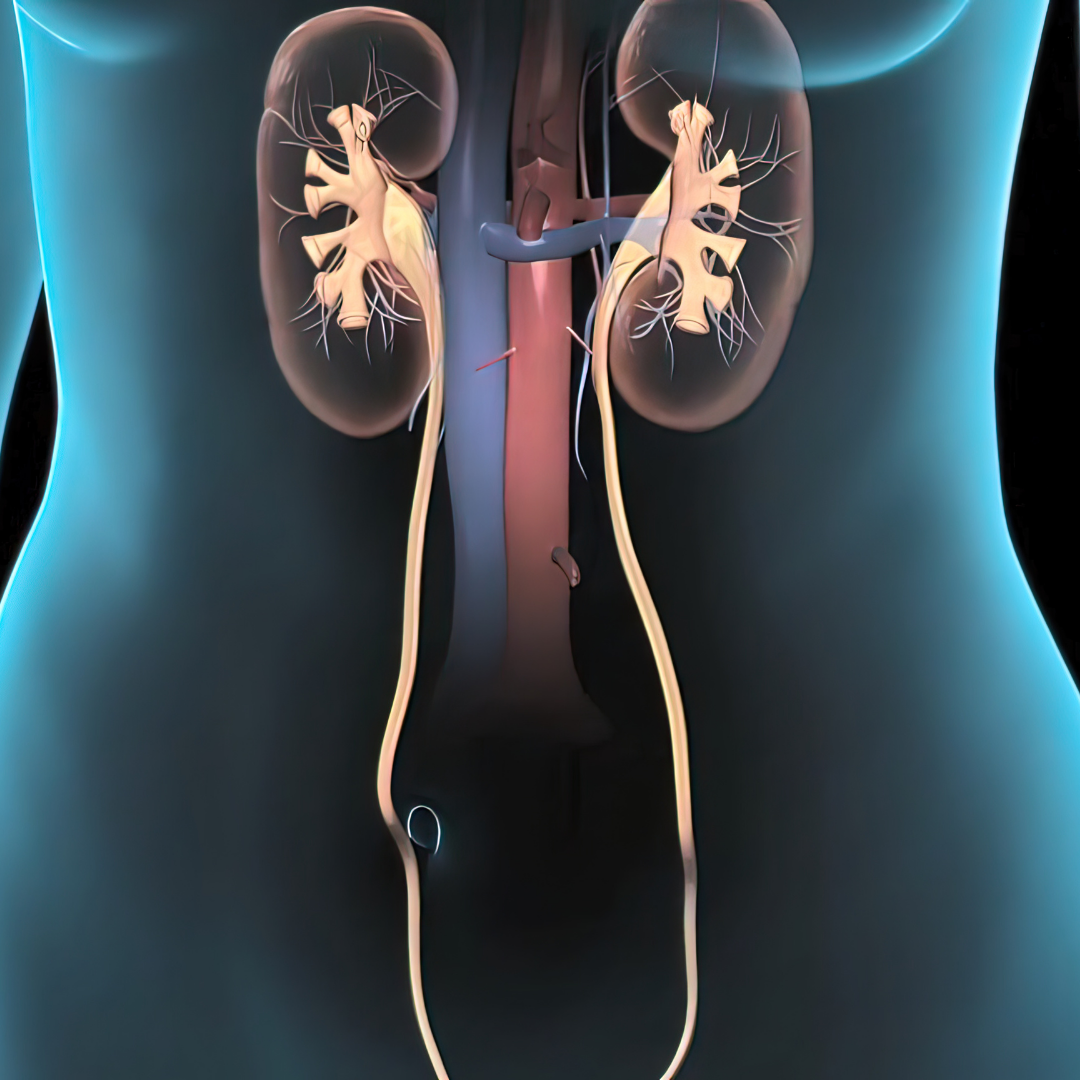 Cost-Effective Kidney Stone Removal Package in Mexicali, Mexico