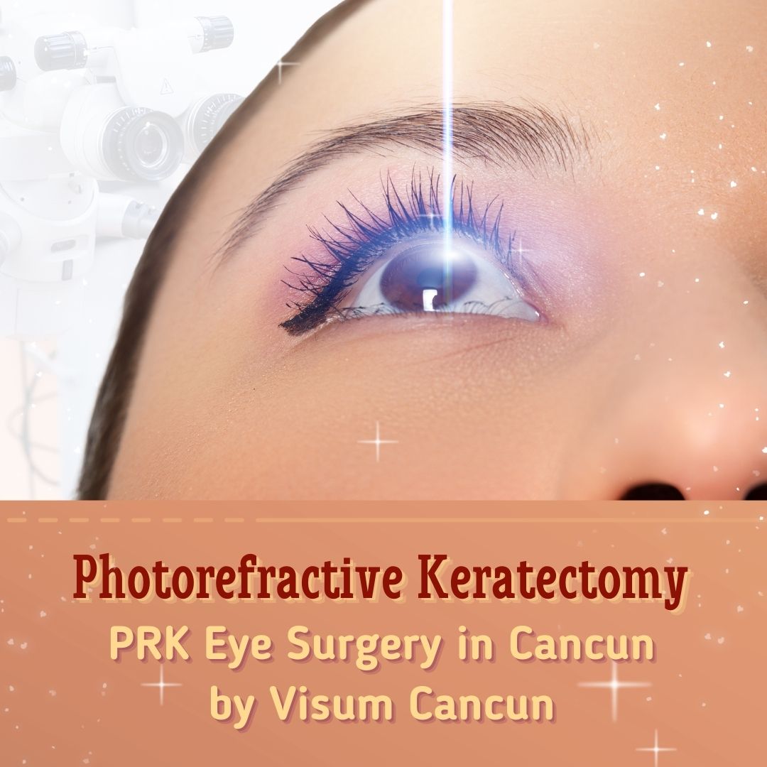 PRK Eye Surgery in Cancun by Visum Cancun