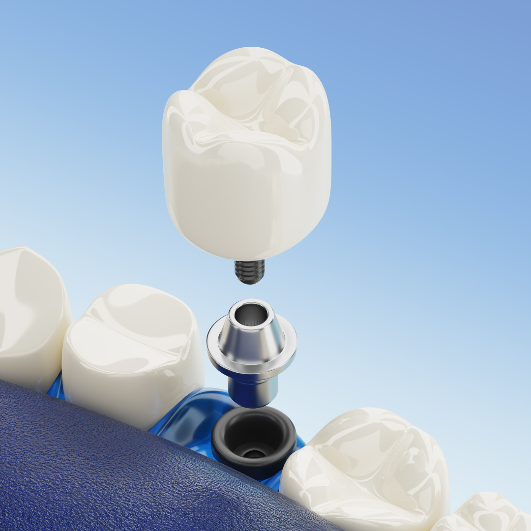 Single Dental Implant Package in Antalya, Turkey