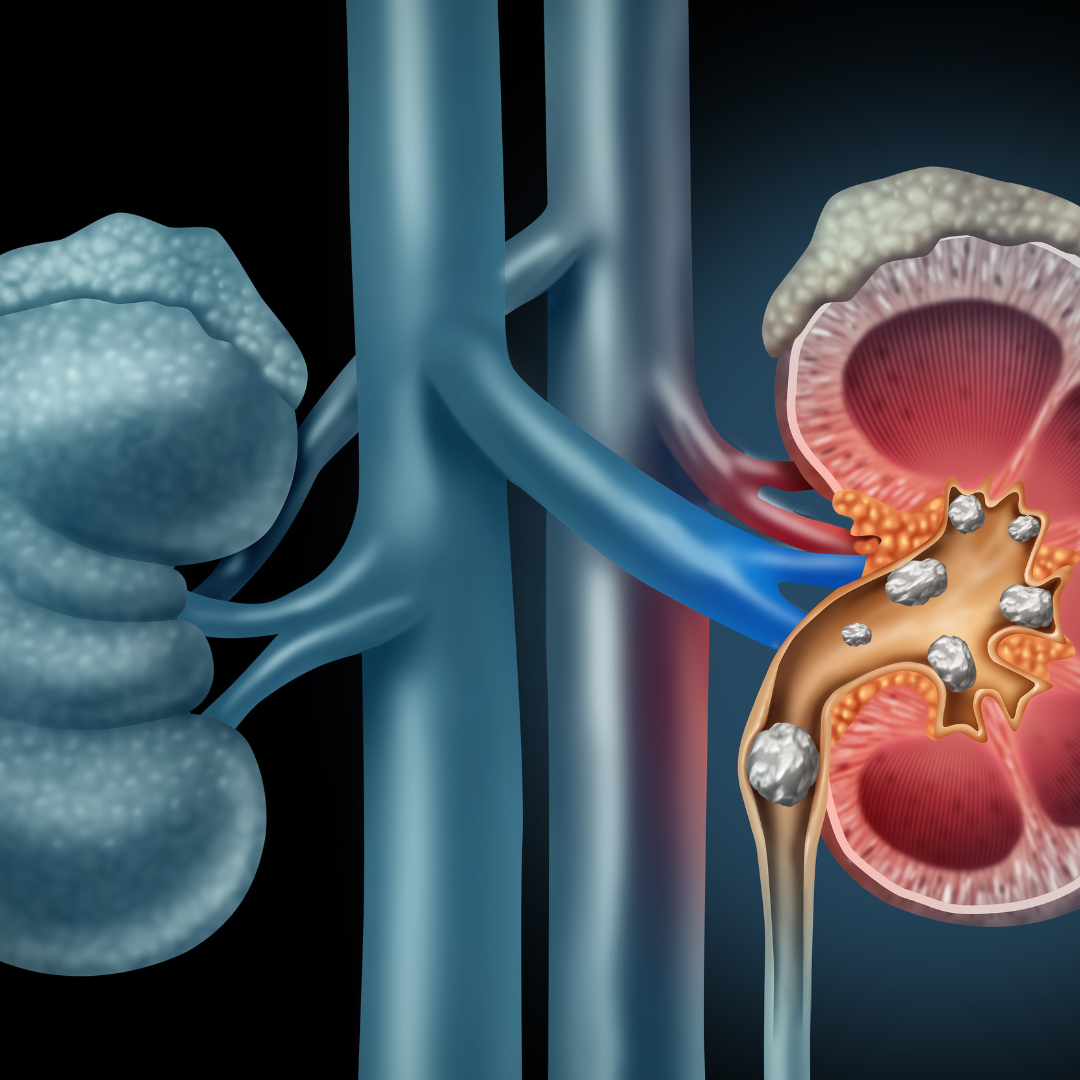 Successful Kidney Stones Surgery in Mexico
