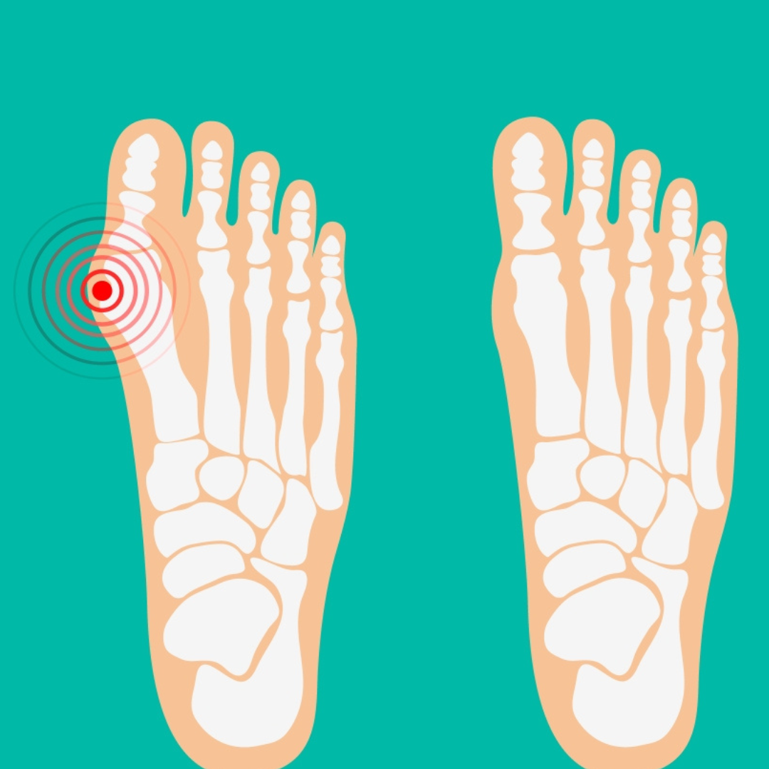 Hallux Valgus / Bunionectomy Surgery with LAPIDUS 3D Technology in Bursa/İstanbul, Turkey