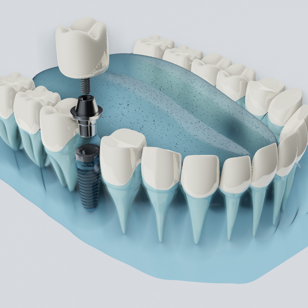 Top Package for Dental Implants in Medellin, Colombia