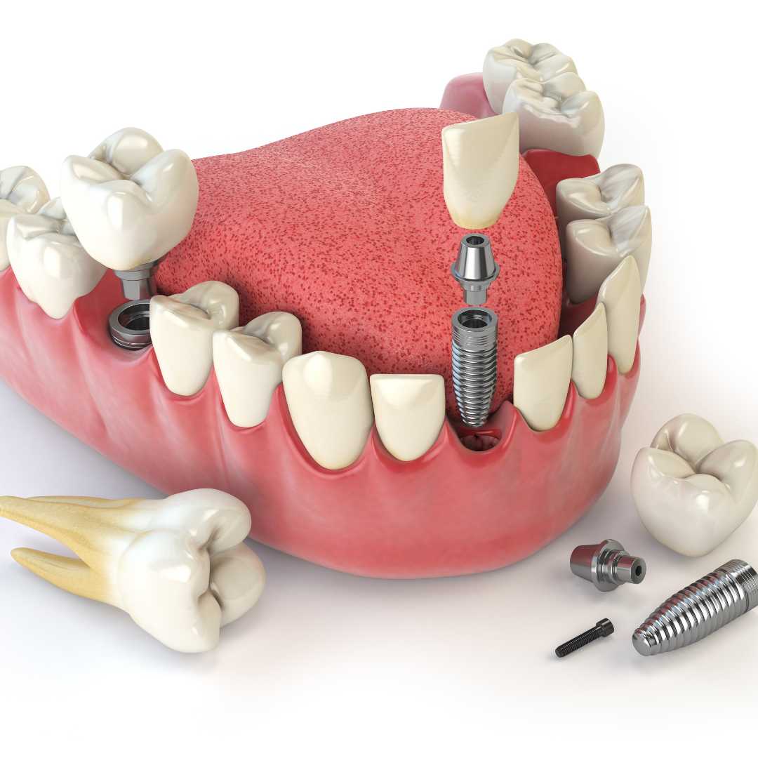 All on 4 Dental Implants Package in Tijuana, Mexico by Quality International Dental Clinic