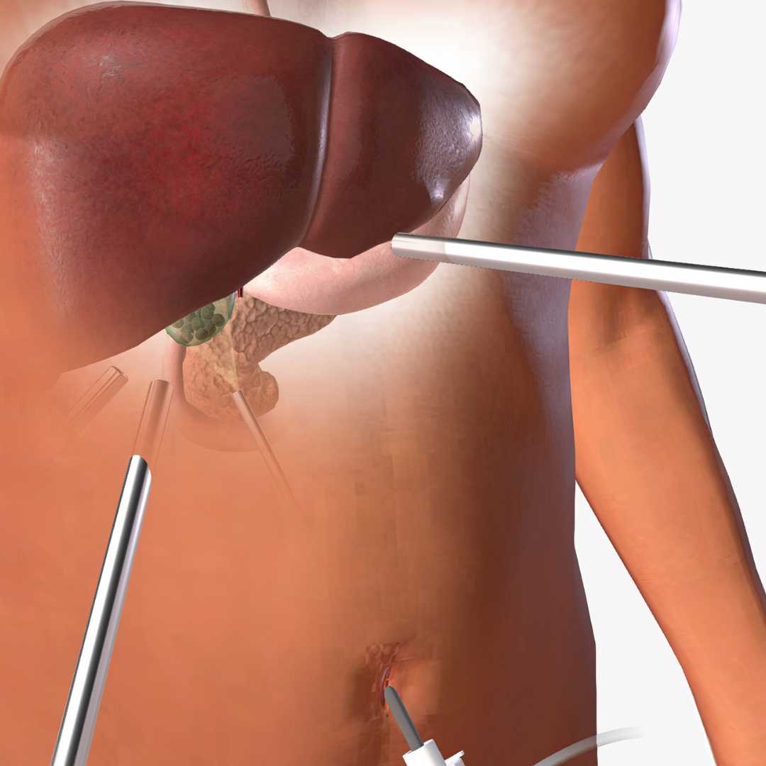 Laparoscopic Gallbladder Removal Surgery Package in Cancun, Mexico by Costamed