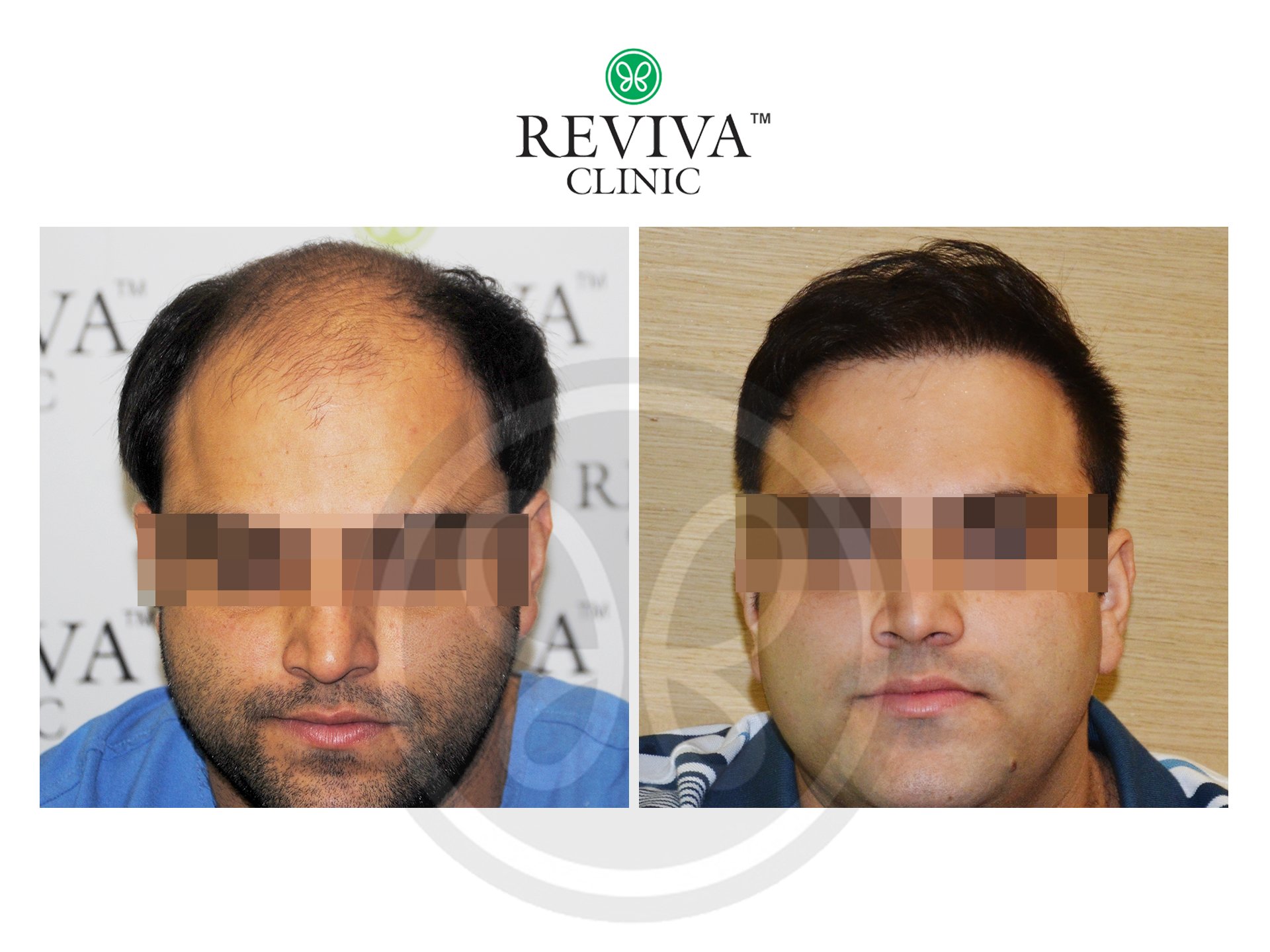 Hair Transplant in Chandigarh, India | Reviva Clinic
