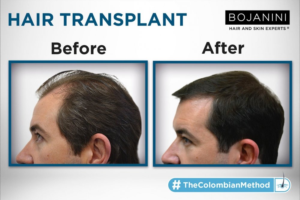 Bojanini Polanco Clinic | Anti-Aging | FUE | Skin Care | Mexico City Bojanini Polanco Clinic | Anti-Aging | FUE | Skin Care | Mexico City